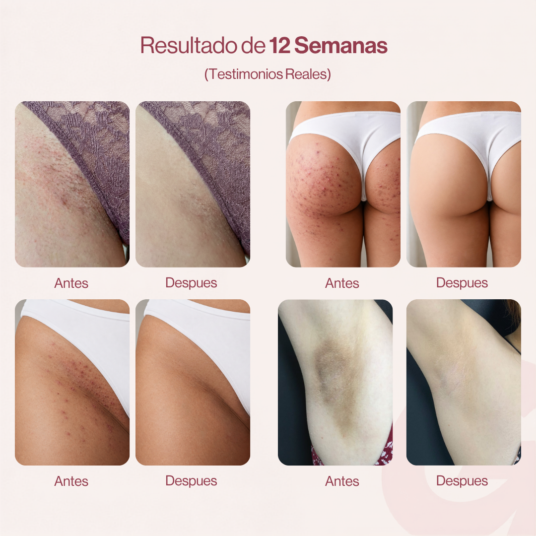 GOZE — Roll-On Corporal para Granitos y Marcas
